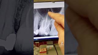 Does gutta percha extrusion cause endodontic failure [upl. by Anahcra228]