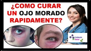 💡 COMO CURAR UN OJO MORADO  3 pasos para tratar y eliminar Moretones o Hematoma facial 2021 ✅ [upl. by Nnyliram]