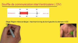 Souffle de la communication interventriculaire quotCIVquot  infos à retenir  audio [upl. by Ojadnama]