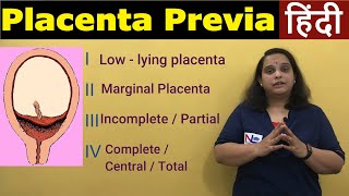 Placenta Previa in Hindi  APH Antepartum HemorrhageTypes Risk factors Symptoms  Nursing Lecture [upl. by Alica]