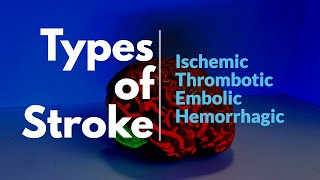 Different Types of Stroke Thrombotic Embolic and Hemorrhagic Pathology [upl. by Hazlip]