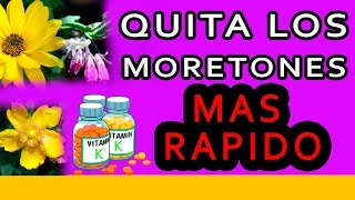 Como quitar los moretones o Hematomas MAS RAPIDO [upl. by Nigen]