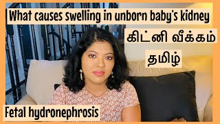 கிட்னி வீக்கம்  Fetal hydronephrosis Tamil Swelling in baby’s kidney in pregnancy  Kidney veekkam [upl. by Koval]