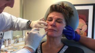 Botox Radiesse Restylane RefynePinski Dermatology and Cosmetic Surgery Chicago [upl. by Eustache]