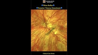 Weiss Reflex Posterior Vitreous Detachment [upl. by Kim]