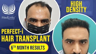 Perfecti Hair Transplant Results  MedLinks Hair Transplant Results  Dr Gaurang Krishna [upl. by Cooperman]