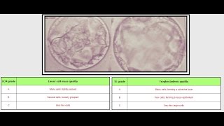 IVF Embryo Grading  AB and BB [upl. by Nitsoj]