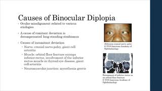 Binocular vs Monocular Diplopia [upl. by Greeley]