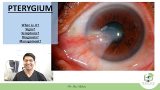 Pterygium What is it Signs Symptoms Diagnosis Treatment I Dr Shaz Rehan 2021 [upl. by Emelin]