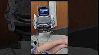 Iliotibial band syndrome ITBS and local injection under ultrasound guidance [upl. by Alimhaj763]