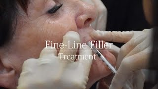 Fine Line Dermal Filler  treatment video [upl. by Natrav]