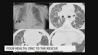 Could zinc be the key to stopping this deadly lung disease [upl. by Nohsid]