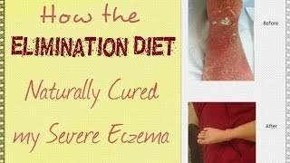 How the Elimination Diet Naturally Cured My Severe Eczema [upl. by Anerbes]