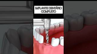 IMPLANTE DENTAL COMPLETO shortsvideo shortsfeed shortsviral shortvideo shortsyoutube shorts [upl. by Fernandez814]