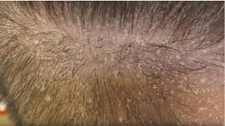 SCALP PSORIASIS FLAKING ALLOVER [upl. by Jandy]