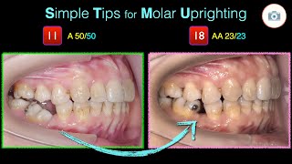 Simple Tips for Molar Uprighting｜【Chris Chang Ortho】CC674 [upl. by Haslett]