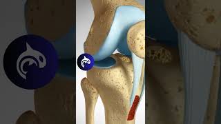 ACL Reconstruction  Patellar Harvest  3D Animation knee kneepain kneerehab [upl. by Kandace396]