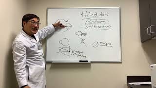 Scotoma in Tilted Disc Syndrome [upl. by Mccarthy]