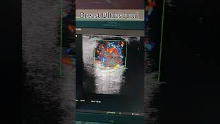 Breast Cancer on Ultrasound Breast medical cancer ultrasound doppler shorts viral health [upl. by Ratcliffe]