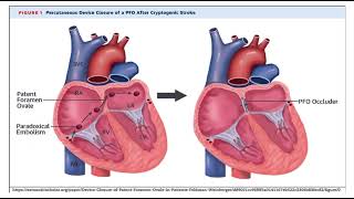 Paradoxical embolism pathology mbbs [upl. by Lleneg]