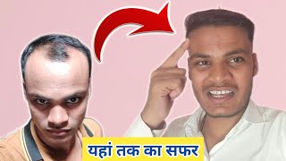 FUE Hair Transplant Results Before And After Hair Style Boys  Hair Transplant Raipur amp Bhopal City [upl. by Skees]