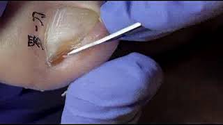 DIY Ingrown Toenail Removal  How to Safely Cut Ingrown Toenails at Home [upl. by Nospmoht25]