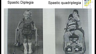 Cerebral Palsy CP  Spastic Diplegia Paraplegia Hemiplegia Sequelae Consequences Treatment Options [upl. by Kall]