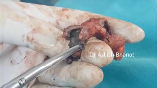 Pilonidal Cyst With Pilonidal Sinus with Hair  Pilonidal Sinus Treatment [upl. by Nassah]