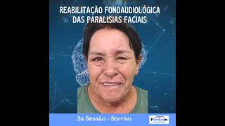 Reabilitação Fonoaudiológica das Paralisias Faciais  Fonovim Fonoaudiologia Neurológica [upl. by Winwaloe]