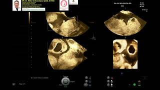 OHSS Ovarian Hyperstimulation Syndrome [upl. by Dlnaod]