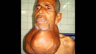 LARGEST Thyroid Swelling Ever Seen On EARTH [upl. by Ahsiner]