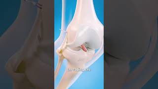 How Surgeons Fix Torn Ligaments in Your Knee short [upl. by Ellerrehc27]