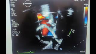 Based on this image what is the sonographer evaluating sp ASD [upl. by Hoenack6]