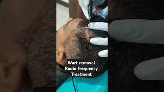 Wart removal verruca removalRadi frequency treatment doctor drharendrakushwahaskincare [upl. by Letisha]