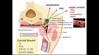 Lemierres Syndrome quotEM in 5quot [upl. by Eimmelc]