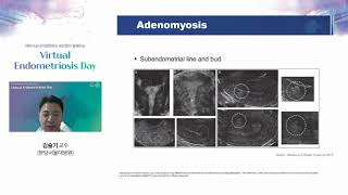 자궁내막증 진단에 다양한 영상검사 활용하기 초음파 MRI Imaging studies for diagnosis of endometriosis 분당서울대병원 산부인과 김슬기 [upl. by Eudosia635]