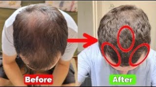 FINASTERIDE and MINOXIDIL Regrowth RESULTS [upl. by Sweyn]