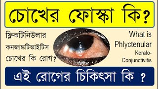 Phlyctenulosis causes symptoms and treatment  Phlyctenulosis  Phlyctenularconjunctivitis [upl. by Creath]