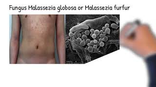 Skin fungal infection Tinea versicolor symptoms causes Treatment [upl. by Ahsien]