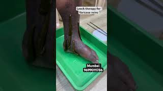 Can leeches remove varicose veins leech therapy for varicose veins shortvideokzhijamareelsdr [upl. by Scrogan]