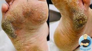 EXTRA THICK HARD SKIN REMOVAL TREATMENT CRAZY BIG CALLUS [upl. by Nahtanod51]