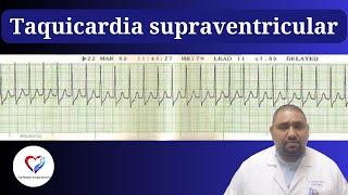 ¿Palpitaciones y mareos 😵 ¡No lo ignores La Taquicardia Supraventricular puede ser peligrosa [upl. by Goodhen]