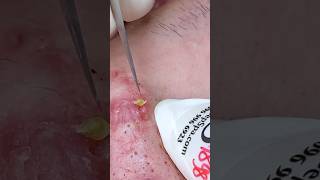 P001  SacDepSpa acne pimple sacdepspa blackheads [upl. by Ocana]