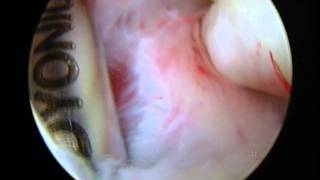 Arthroscopic Elbow Arthrofibrosis Release  Video 1 [upl. by Channa]