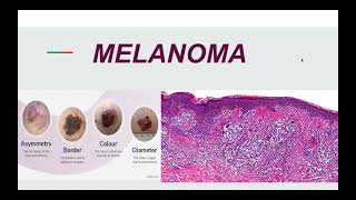 Malignant Melanoma Pathogenesis Morphology and Clinical picture [upl. by Inaluahek]