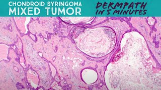 Chondroid syringoma  Mixed tumor Dermpath in 5 Minutes dermatology pathology dermatopathology [upl. by Eesdnyl]