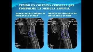 CASOS CLINICOS DE COLUMNA VERTEBRALDr Ocar Hernández Bocanegrawmv [upl. by Kcirredal]