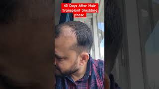 Day 45 After Hair Transplant  Shedding Phase besthairtransplant [upl. by Eiznikam]