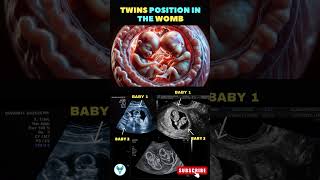 Twinning inside the belly ❤️❤️ Twins  Twin pregnancy  Twin baby bump shortsfeed pregnancy baby [upl. by Hardy]