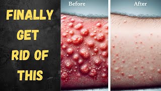 How I Got Rid of My Keratosis Pilaris on my Arms [upl. by Draper]